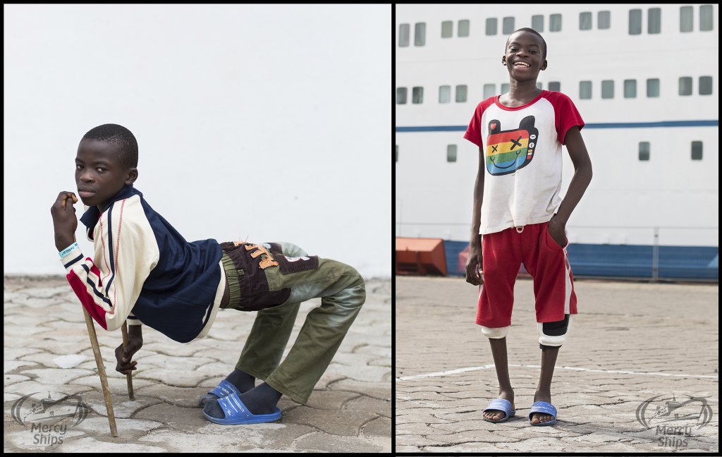 picture of a boy before and after leg surgery on the mercy ships